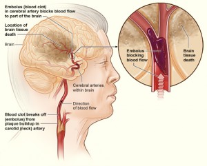 Blood clot from plaque buildup