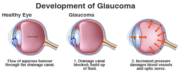 glaucoma