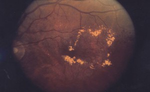 Diabetic Macular Edema