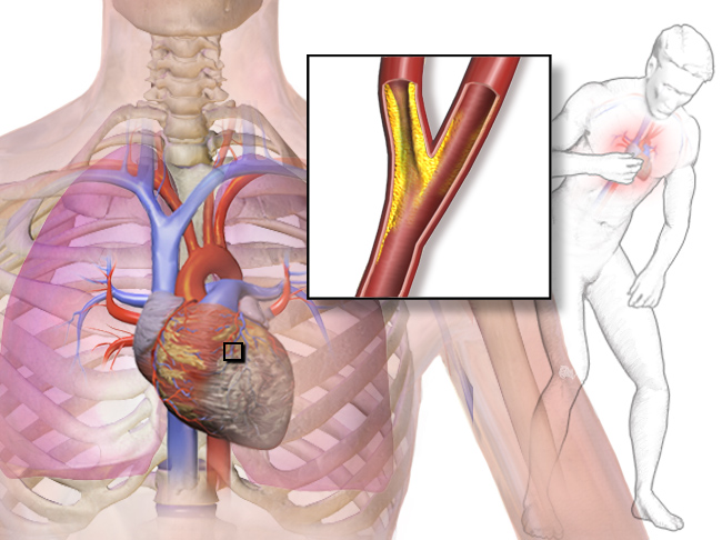 Angina Pectoris Definition