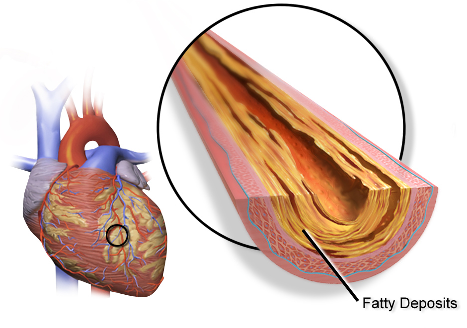 Blausen_0257_CoronaryArtery_Plaque