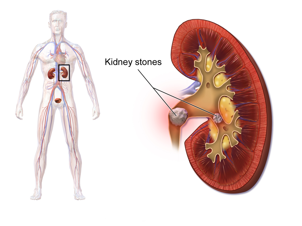 KidneyStones