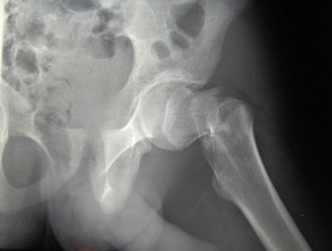 hip fracture