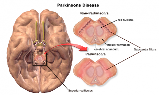 parkinson's substantia nigra