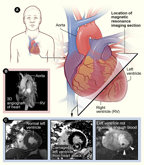 cardiac mri scan