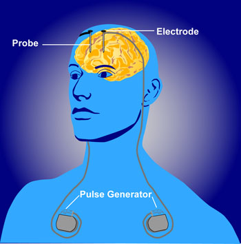 People and Parkinson's - Part 2