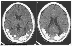 Calcium stones in brain