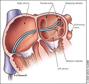 Catheter Ablation