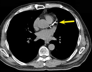 Coronary Calcium Scan