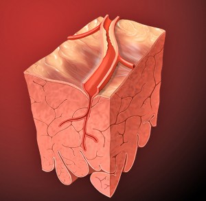 Artery lesion