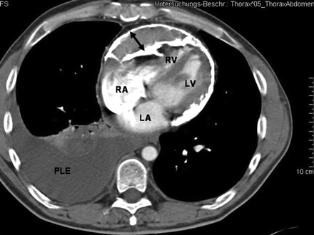 AF Calcification