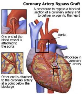 heart by pass