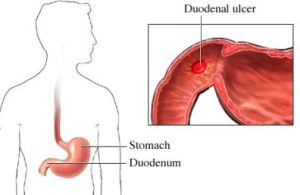 h. pylori infection