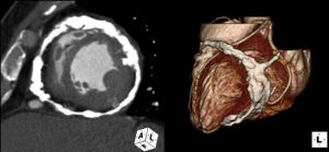 calcification of heart