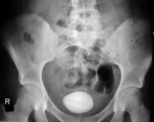 Bladder Stone