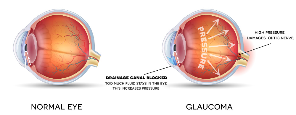 glaucoma