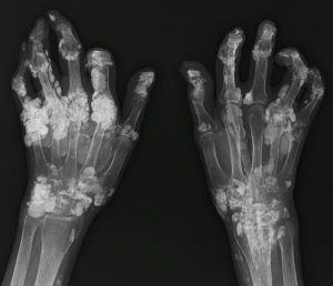 arthritis