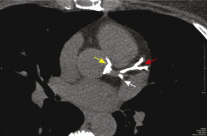 what is a coronary calcium scan