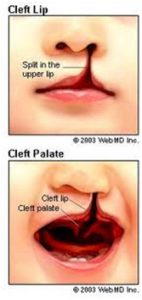 cleft-lip or palate