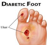 diabetic foot