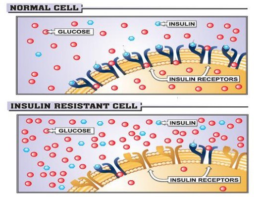 insulin resistance