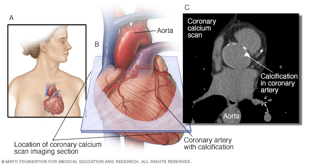 calcium scan