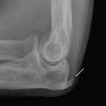 elbow spur