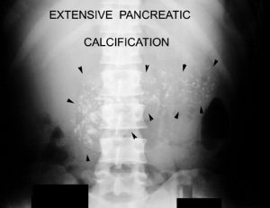 pancreatic calcification