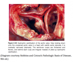 aortic valve