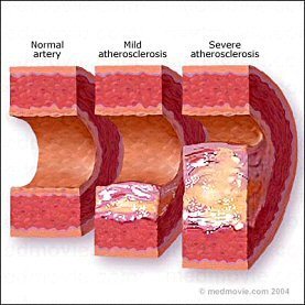 articles-atherosclerosis-1