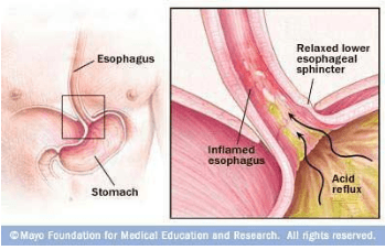 Proton pump inhibitors side effects