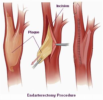 Carotid Artery Symptoms