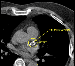 calcified heart arteries