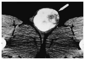 calcified testis