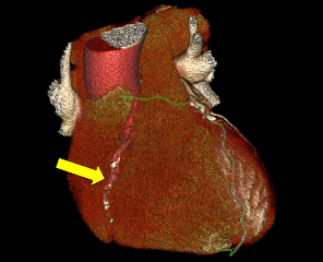 Ca occlusion