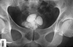 bladder stones