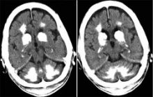 Calcified Brain