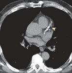 Calcification in Heart