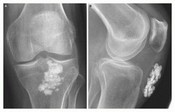 Calcified knee