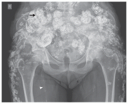 calcified pelvis