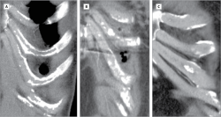 calcified ribs