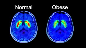 obesity in children