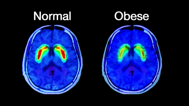 Obesity in Children and Mg deficiency = insulin resistance