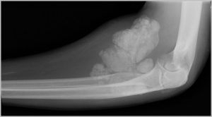 calcified elbow
