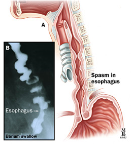 esophageal spasm