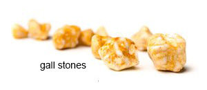 gall stones
