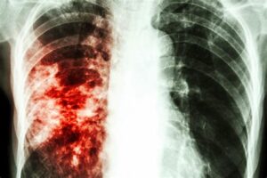 tuberculosis